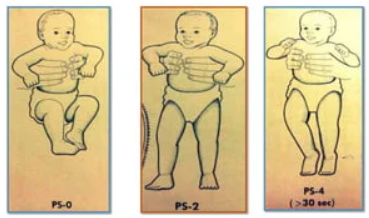 <ul><li><p>primitive reflex - spinal cord</p></li><li><p>develops extensor tone</p></li><li><p>stimulate feet with firm contact to floor or table => co-contraction of flexors and extensors of the legs</p></li><li><p>other wording from internet: elicited when placing weight on the sole of the foot resulting in extension of the legs</p></li></ul><p></p>