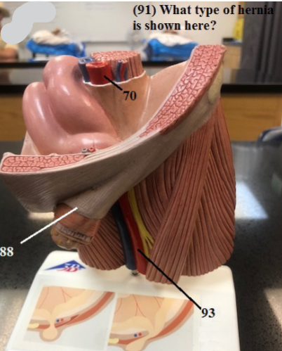 <p>Label 70, 88, 93<br>What Type of Hernia is Shown here?</p>