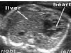 <ul><li><p>liver herniates to the chest </p></li><li><p>mediastinal shift to left </p></li><li><p>ascites and hydrops</p></li></ul><p></p>