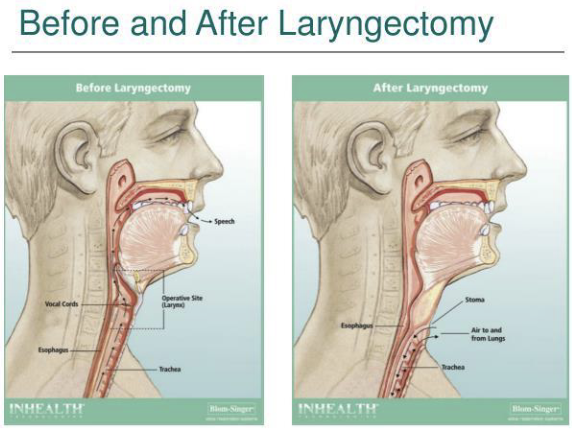 <p>Trachea is dissociated from the upper airway</p><p>Permanent stoma is created in the neck for breathing </p>