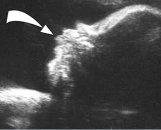 <p>persistent protrusion of fetal tongue </p><ul><li><p>associated with </p><ul><li><p>beckwith-wiedemann</p></li><li><p>downs syndrome</p></li></ul></li></ul><p></p>