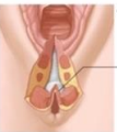 <p>Perineal laceration involving both the internal and external anal sphincter and the anal epithelium </p><p>-Requires absorbable sutures and single dose of cefoxitin</p>
