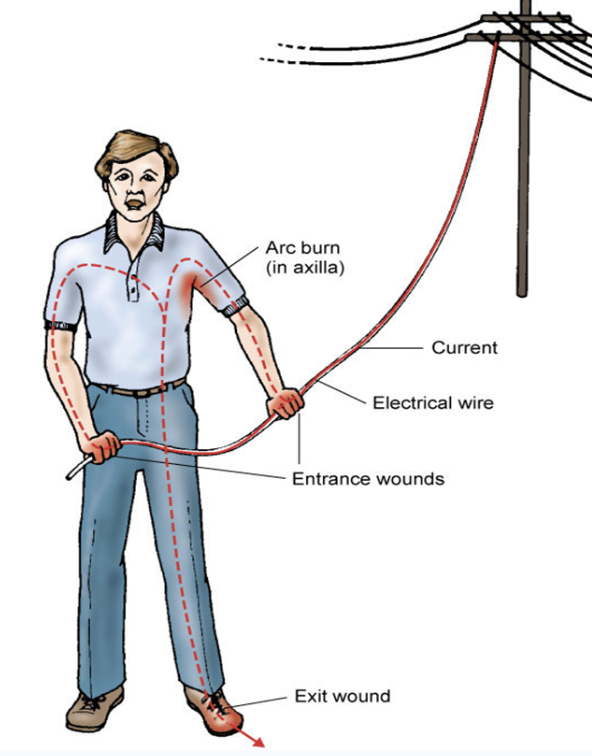 <ul><li><p>caused by contact w/ electrical sources </p></li><li><p><strong>AC (alternating current) injuries have HIGHER risk of cardiopulmonary arrest by VFib compared to DC injuries </strong></p><ul><li><p>AC can cause tetany → keeps circulating through </p></li></ul></li><li><p>things that impact severity: type and pathway of current, duration of contact, environmental conditions, body tissue resistance </p></li><li><p>electroporation → your body cells are an excellent conduit for electricity to travel through your body → entry and exit wound!</p></li><li><p>wound can appear superficial!!!</p></li></ul><p></p>