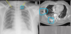<p>Dx: CXR and CT chest</p><p>Tx:</p><p>- Analgesia/Pain Meds! so they breathe and don't dvlp PNA!</p><p>- Repeat CXR</p><p>- Incentive Spirometry</p><p>- Intubation & ventilatory support for patients with multiple rib fx/lung disease</p><p>OR: </p><p>- Open reduction of rib fractures (rib plating)</p>