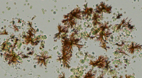 <p>Bilirubin Crystals</p>