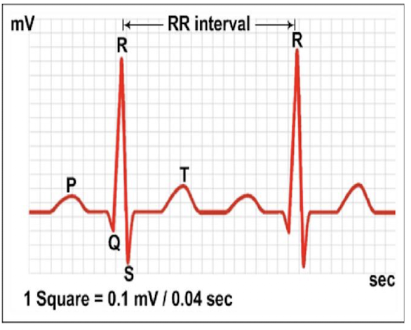 <p>heart rate: time between two p waves or two q waves</p><p>rhythm: regular pattern</p><p>waves analysis: presence and shape</p><p>segment length: constant</p>