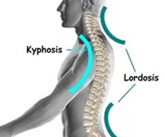 <p>concave curvature (swayback), most commonly seen in the lumbar</p>