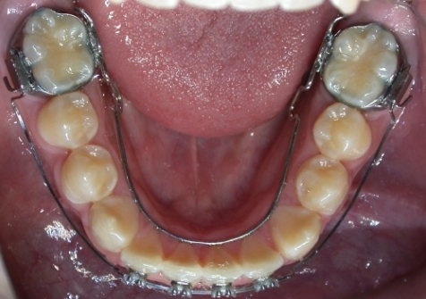 <p>Lingual Arch</p>