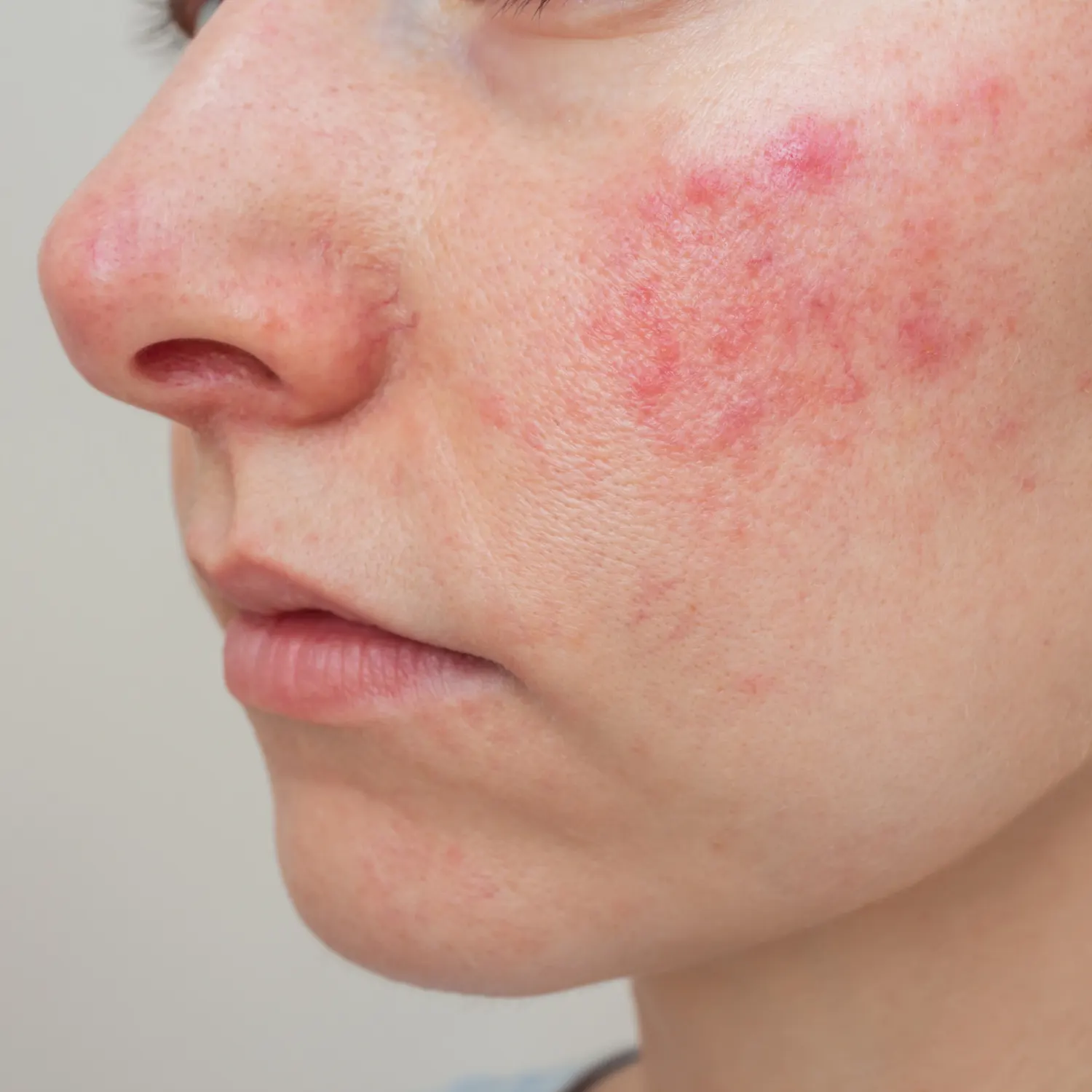 <p>Autoimmune diseases</p><p>Acne vulgaris</p><p>Eczema</p><p>Hormonal conditions</p><p>Rosacea (image)</p>