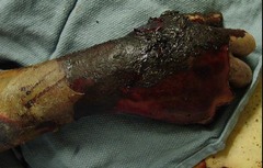 <p>D. The involved areas of this 3rd-degree burn would be expected to be mostly insensate</p><p>The answer is D. The answer is D. 3rd-degree burns are often insensate; withholding pain medication is not necessary; one hand is about 2-3% TBSA, and prophylactic antibiotics are not recommended.</p>
