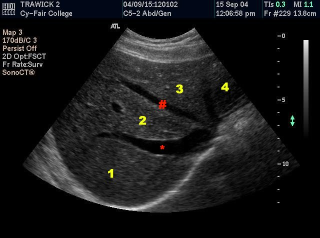 <p><strong>The number 4 corresponds specifically to which of the following</strong></p><p>Anterior segment left lobe</p><p>Lateral segment left lobe</p><p>The left lobe</p><p>Left branch of the left hepatic artery</p>