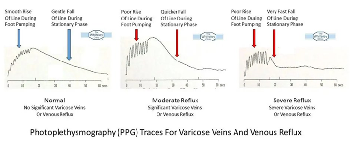 <p>the timing of blood return to the region indicates presence or absence of reflux </p><ul><li><p>venous reflux is VRT is less than 20 seconds</p><ul><li><p>large slope (faster rise) = worse </p></li></ul></li></ul><p></p>