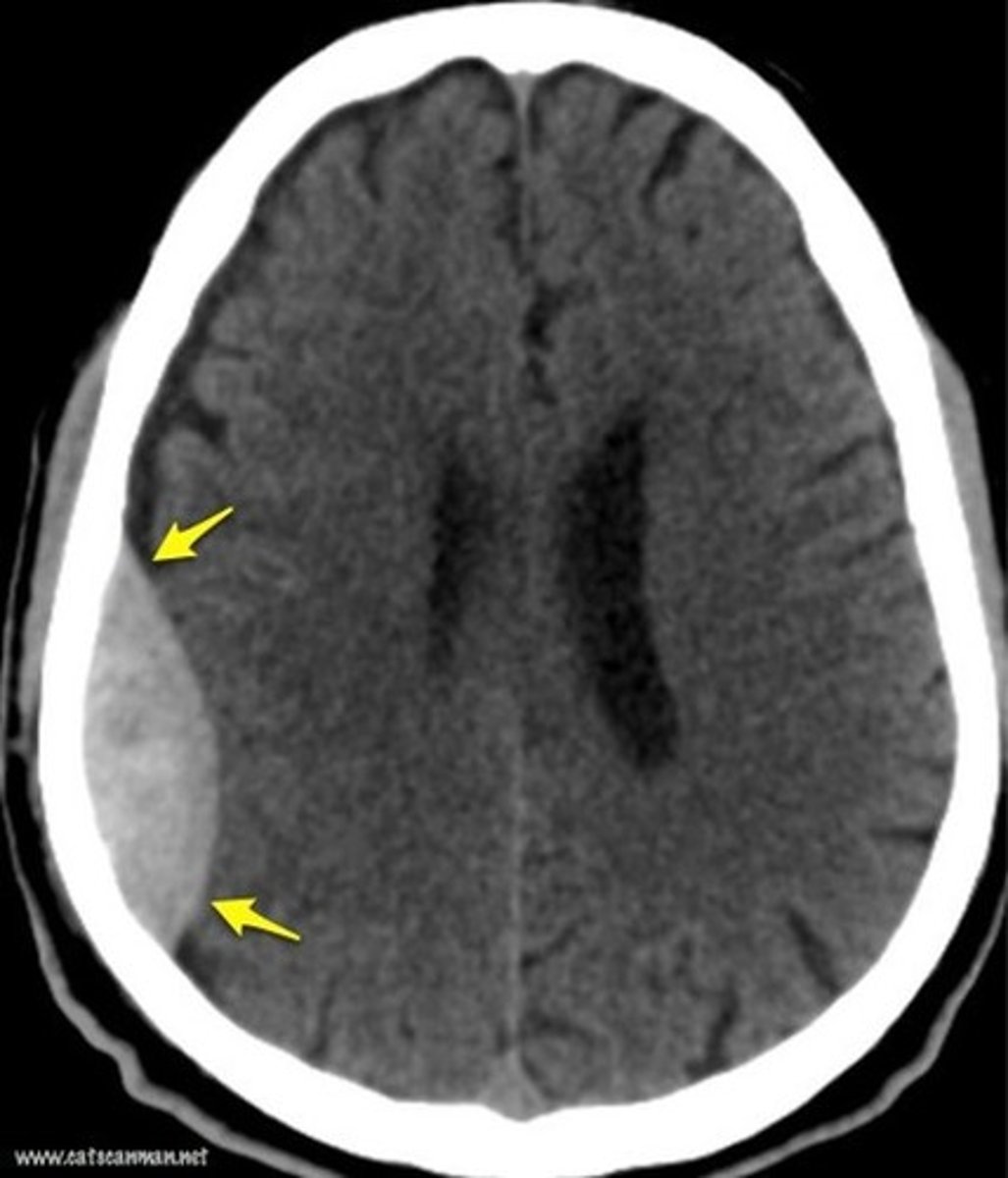 <p>located b/w skull & dura mater</p><p>confined by sutures</p><p>CAN cross midline</p><p>common cause: skull fracture</p>