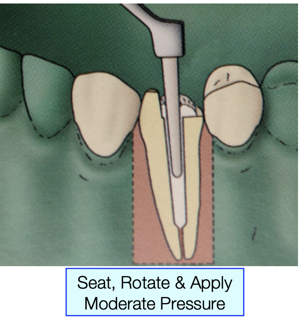 <p>seat, rotate, and apply moderate pressure </p>