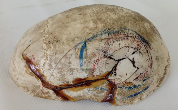 <p>Questions</p><ol><li><p>What is the specimen being examined?</p></li><li><p>What are the type and specific descriptive features of the primary fracture and its radiating components?</p></li><li><p>What type of causative instrument and force mechanics produce this injury?</p></li><li><p>How is the time of death estimated?</p></li><li><p>What are the possible causes of death?</p></li><li><p>What is the final diagnosis for this specimen?</p></li></ol><div data-type="horizontalRule"><hr></div><p>Answers</p><p></p>