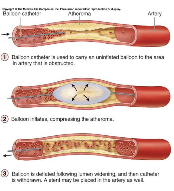 <p>occlusion that can lead to a myocardial infarction (heart attack); leads to prolonged coronary blockage, areas of cell death are repaired with noncontractile scar tissue</p>