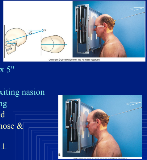 <p>collim of PA AXIAL CALDWELL — NASAL</p>