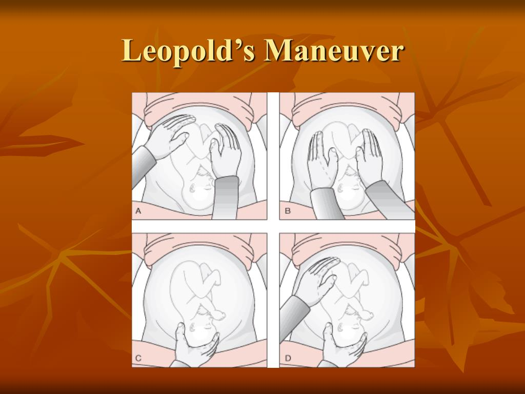 <ol><li><p><span style="color: rgb(71, 135, 218);">Is <strong>fundus hard or soft</strong>?</span></p></li></ol><ul><li><p><span style="color: rgb(71, 135, 218);"><strong>soft</strong>=butt </span>(good)</p></li></ul><ol start="2"><li><p><span style="color: rgb(149, 29, 243);">Find <strong>fetal back</strong></span></p></li></ol><ul><li><p><span style="color: rgb(149, 29, 243);">place monitor here</span></p></li></ul><ol start="3"><li><p><span style="color: rgb(30, 141, 73);"><strong>Squeeze fingers together above pelvis.</strong></span></p></li></ol><ul><li><p><span style="color: rgb(30, 141, 73);">if no→ head is engaged or reached mid point of pelvis</span></p></li></ul><ol start="4"><li><p><span style="color: rgb(235, 83, 194);">Is <strong>head flexed</strong>?</span></p></li></ol><ul><li><p><span style="color: rgb(235, 83, 194);">chin tucked =good</span></p></li></ul><p></p><p></p>