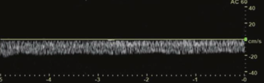 <p>A venous doppler waveform demonstrates minimal respiratory variation. This most likely represents:</p>
