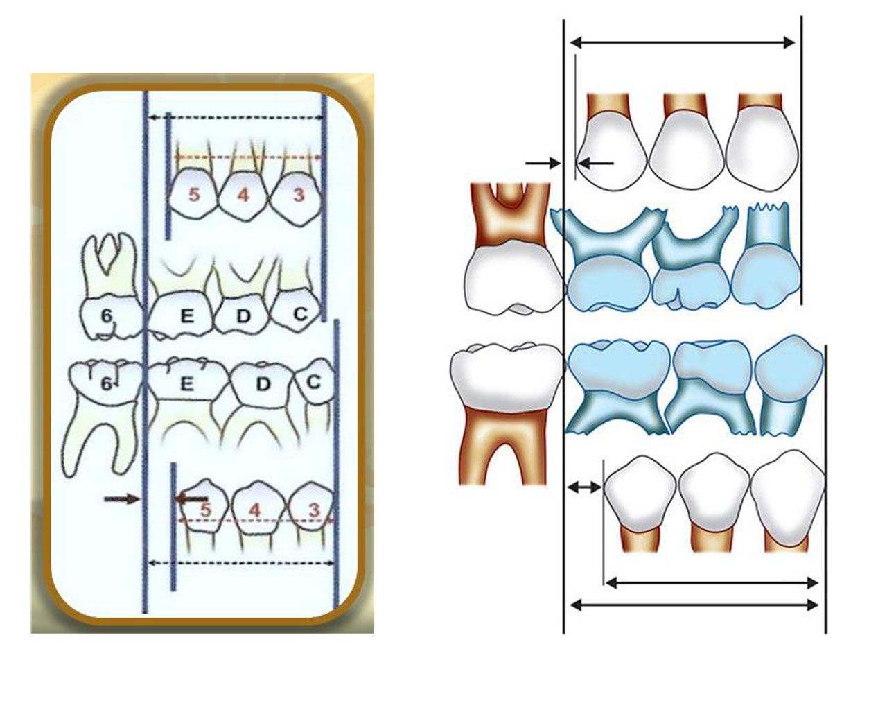 <p>Define the following:</p><p>Size difference where <u>primary </u><strong><u>molars </u></strong><u>(D, E)</u> are <strong>wider</strong> than their <u>permanent replacements (</u><strong><u>premolars</u></strong><u>)</u>.</p>