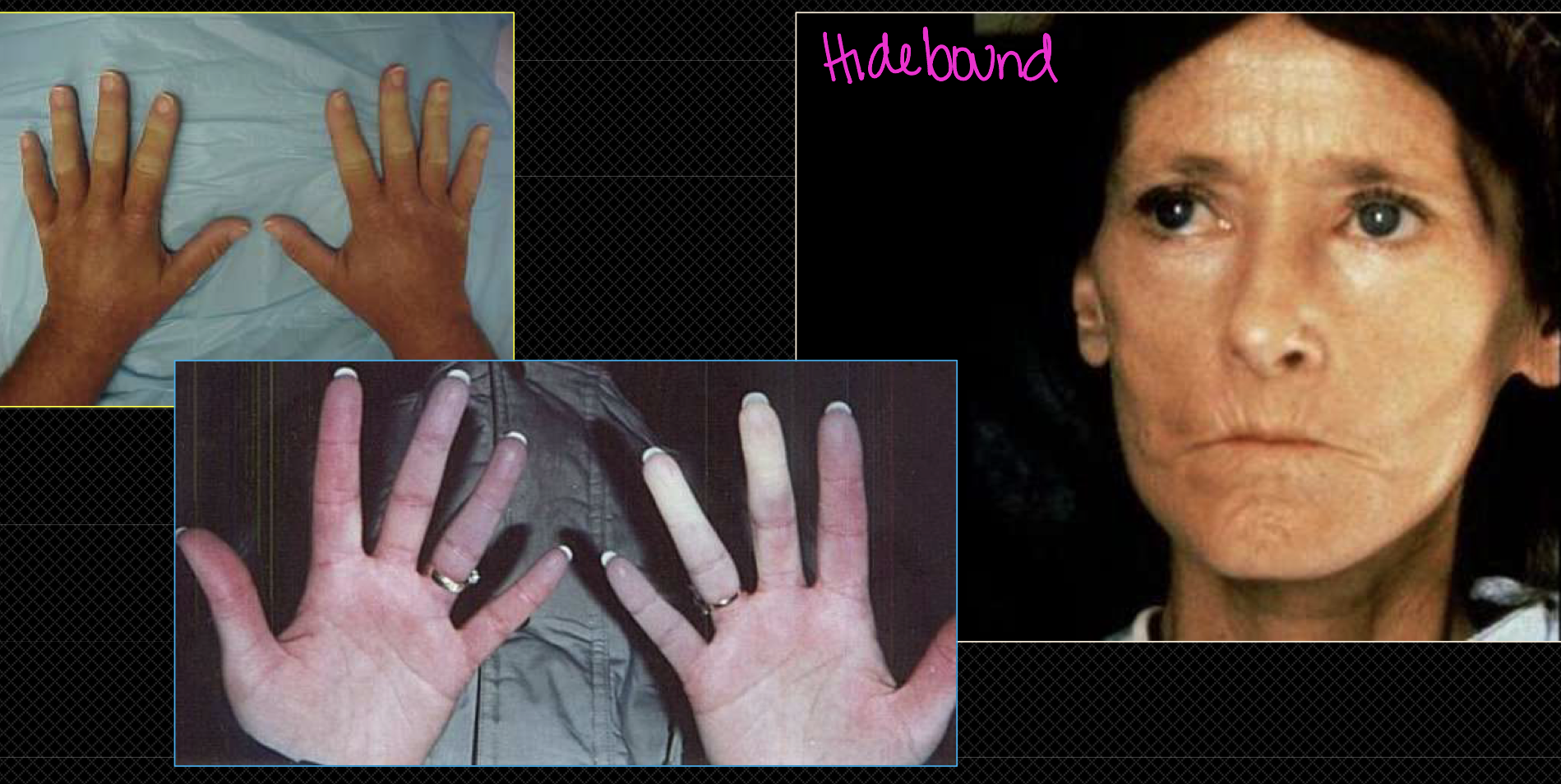 <p>Scleroderma (PSS) skin findings progression </p>