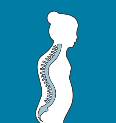 <p>excessive outward curvature of the spine, causing hunched apperance</p>