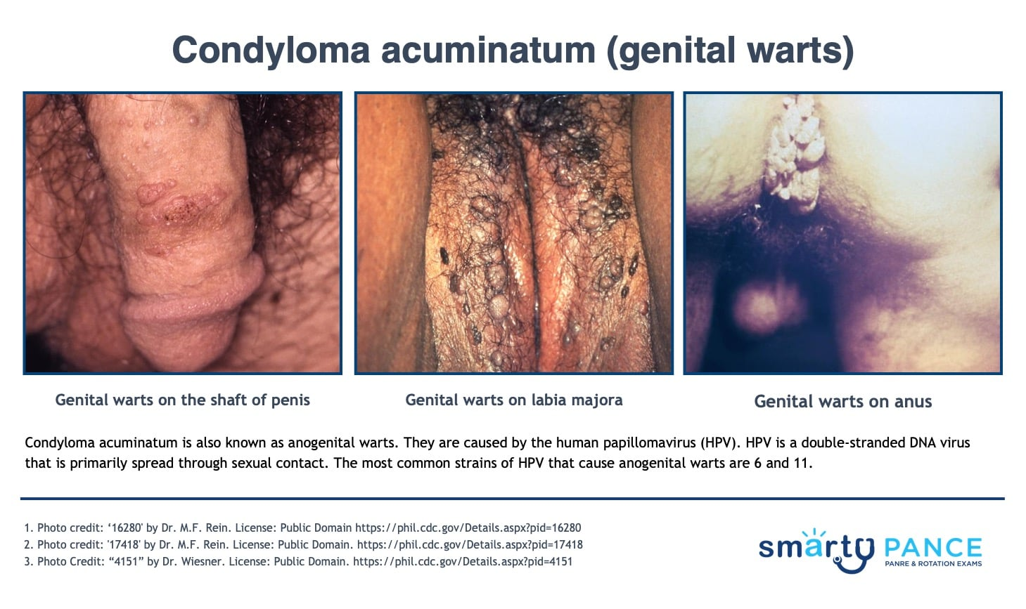 <p>Soft, skin-colored, fleshy growths caused by human papillomavirus types 6 and 11 </p><p>-Dx: clinical</p><p>-Tx: imiquimod if patient applied, TCA therapy in office </p>