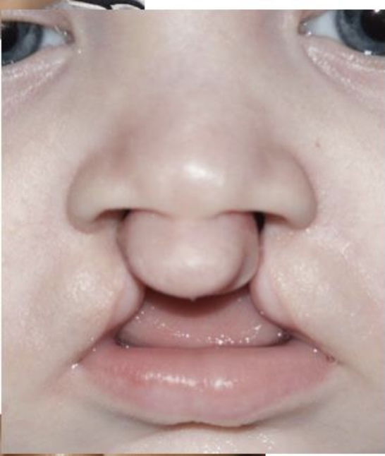 <p>Question #: 20 The cleft pictured in the figure is an example of a ______ cleft. <br>A. Incomplete bilateral <br>B. Complete unilateral <br>C. Incomplete bilateral <br>D. Complete bilateral</p>