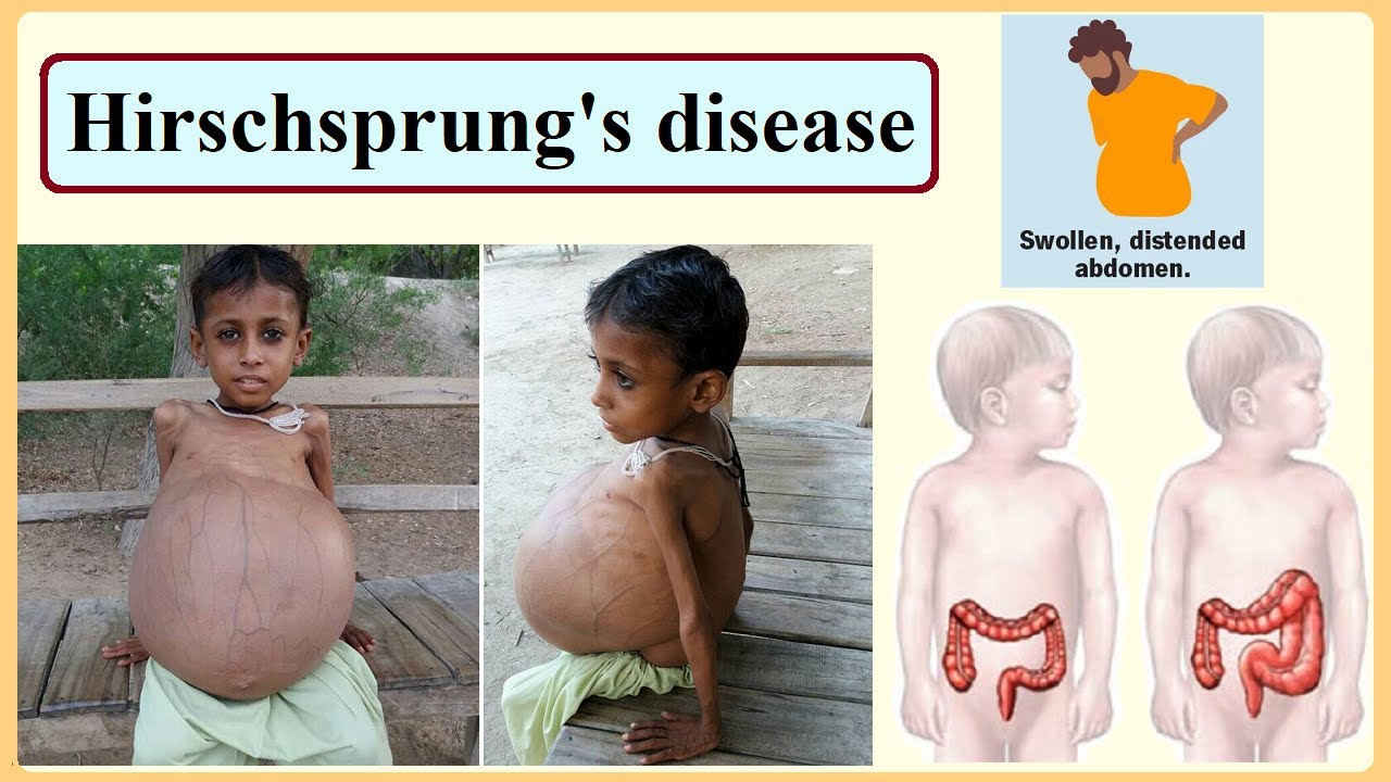 <ol><li><p><span style="color: rgb(236, 108, 108);"><strong>foul smelling stool</strong></span></p></li><li><p><span style="color: rgb(51, 95, 151);"><strong>ribbon-like or pellet-like</strong></span> poop</p></li><li><p><span style="color: rgb(38, 171, 96);"><strong>distention</strong></span></p></li><li><p><span style="color: rgb(235, 36, 201);"><strong>undernourished, anemic </strong>appearance</span></p></li><li><p><span style="color: rgb(205, 126, 53);"><strong>palpable fecal mass</strong></span></p></li></ol><p></p>