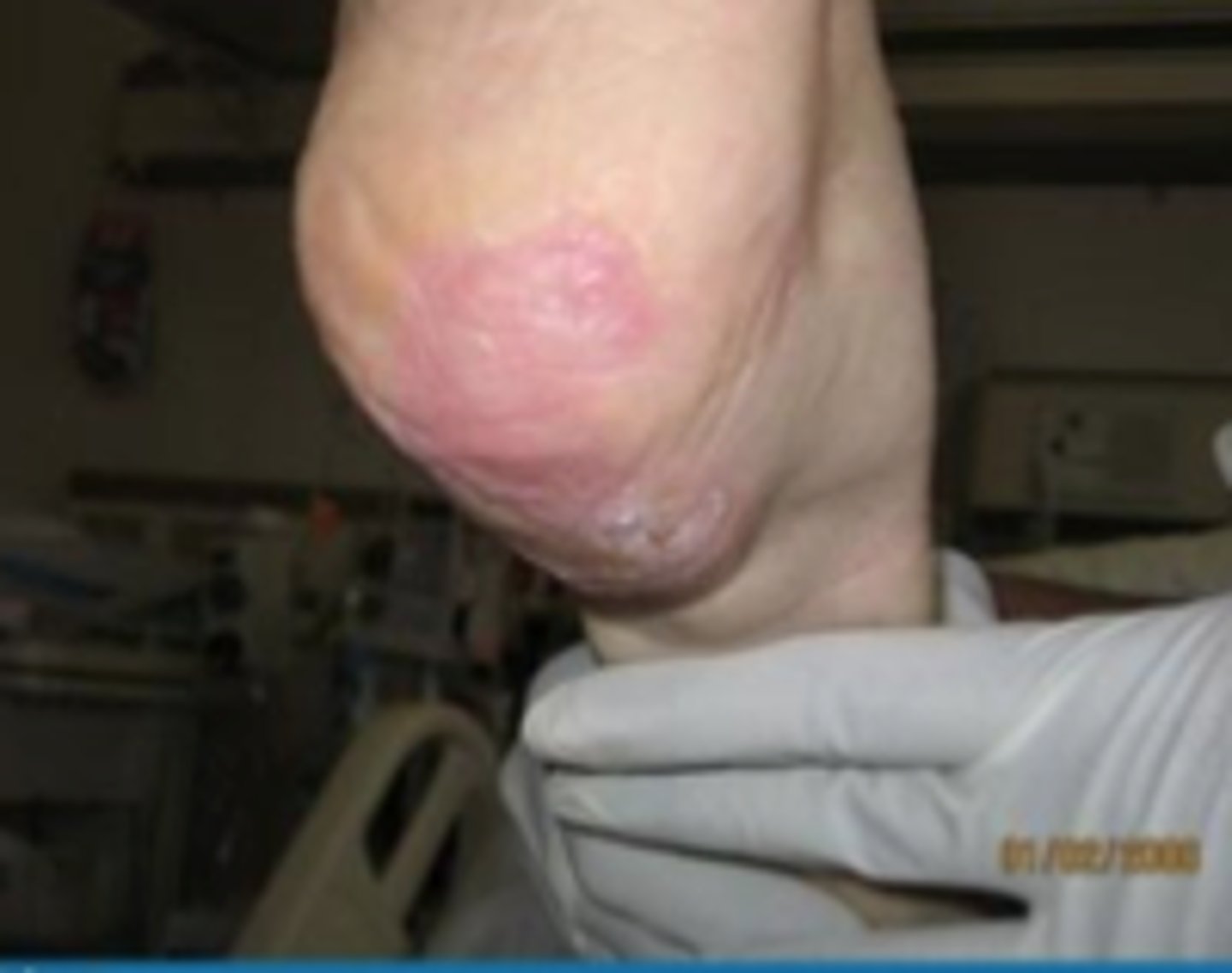 <p>intact skin with localized area of nonblanchable erythema</p>