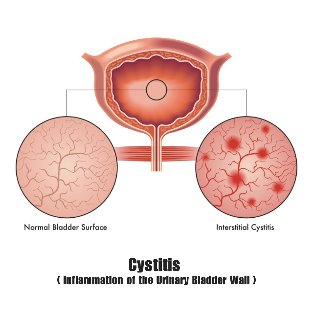 <p>Cystitis</p>