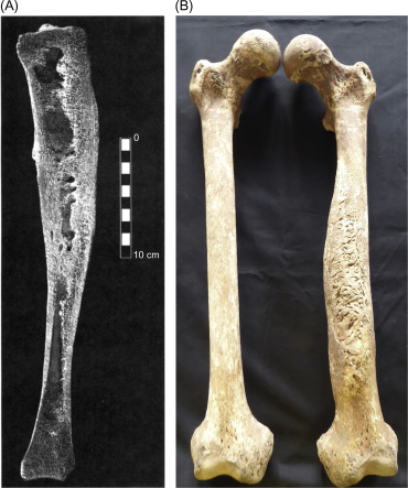 <p>a bacterial infection of the bone tissue</p>