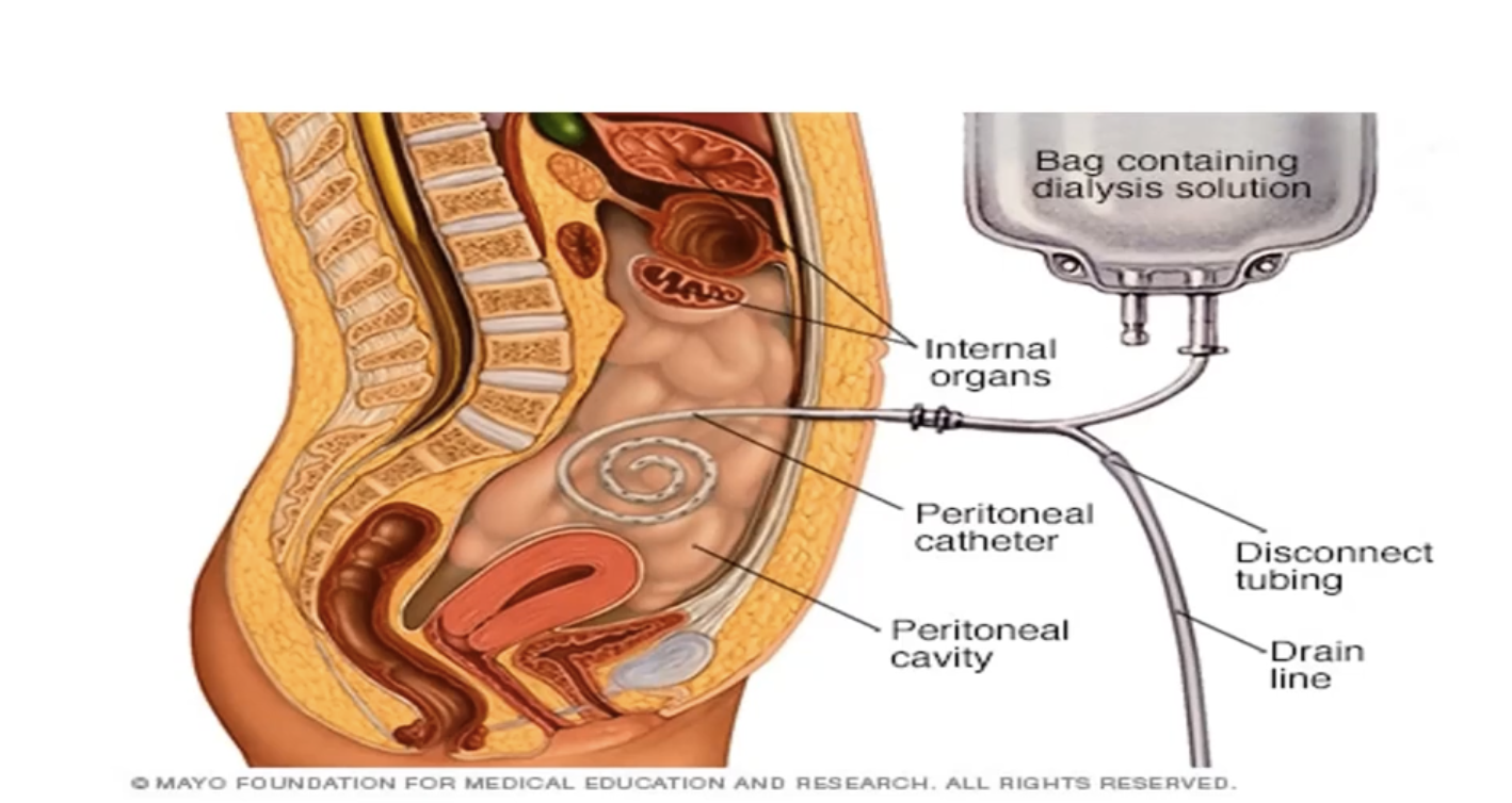 <ul><li><p>Catheter inserted in the peritoneal cavity </p></li><li><p>Dialysate is pumped in through the catheter and helps to remove the waste products in the body</p></li><li><p>pumped in and out of the peritoneum many times to achieve full filtration </p></li></ul><p></p>