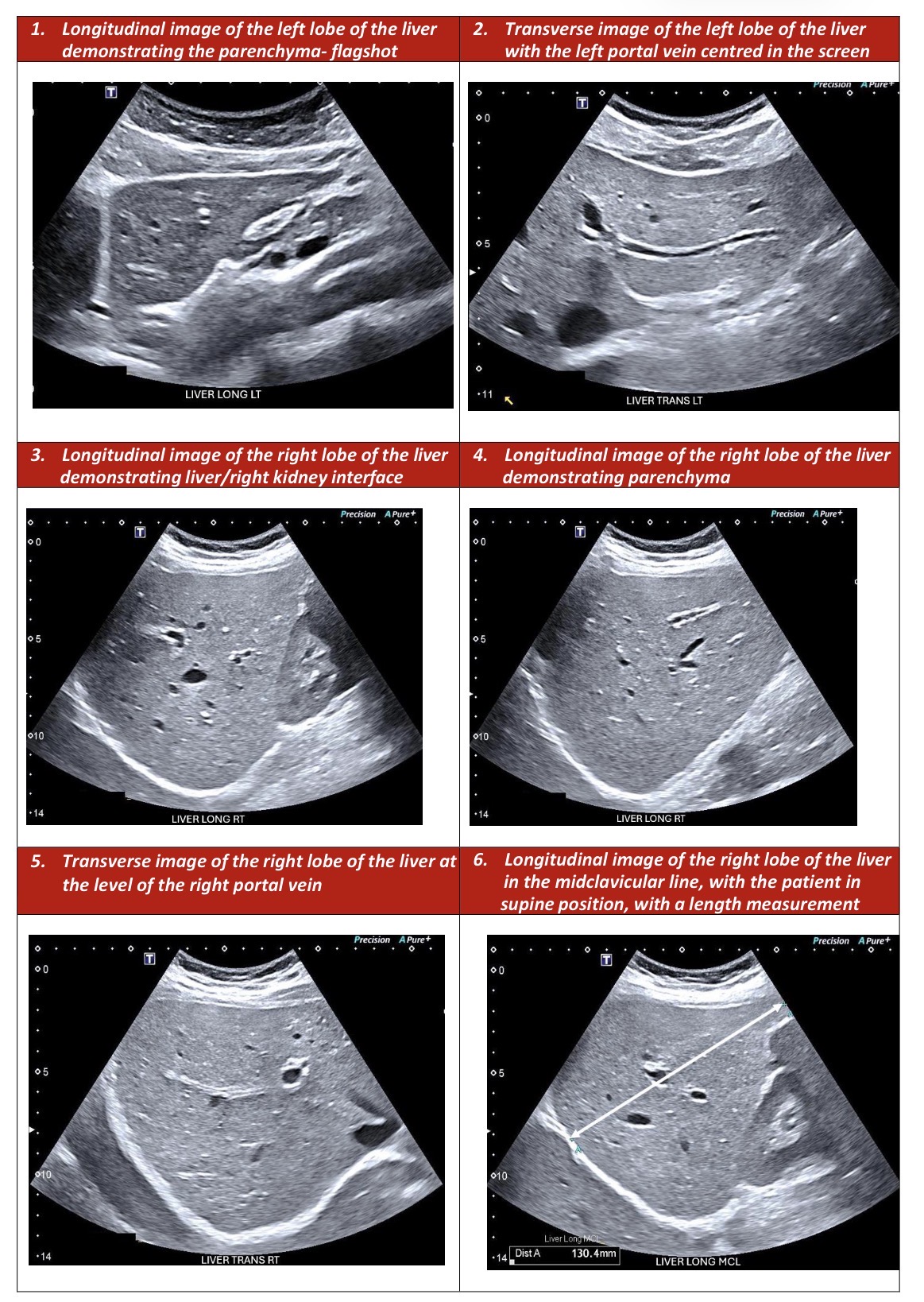 <p>After the survey</p><ul><li><p>Starting in the longitudinal plane obtain a longitudinal image of the right lobe of the liver and the right kidney demonstrating a clear interface and echogenicty of each organ (image 1)</p></li><li><p>Angle (slightly) laterally (or sometimes medially) in the right lobe and obtain an image of the liver parenchyma (image 4)</p></li><li><p>Turn to transverse and obtain an image of the liver at about the level of the right portal vein (image 5)</p></li></ul><p>Do u need oblique ?</p><p></p>