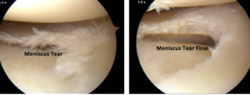 <p><strong>Arthroscopy <br></strong></p>