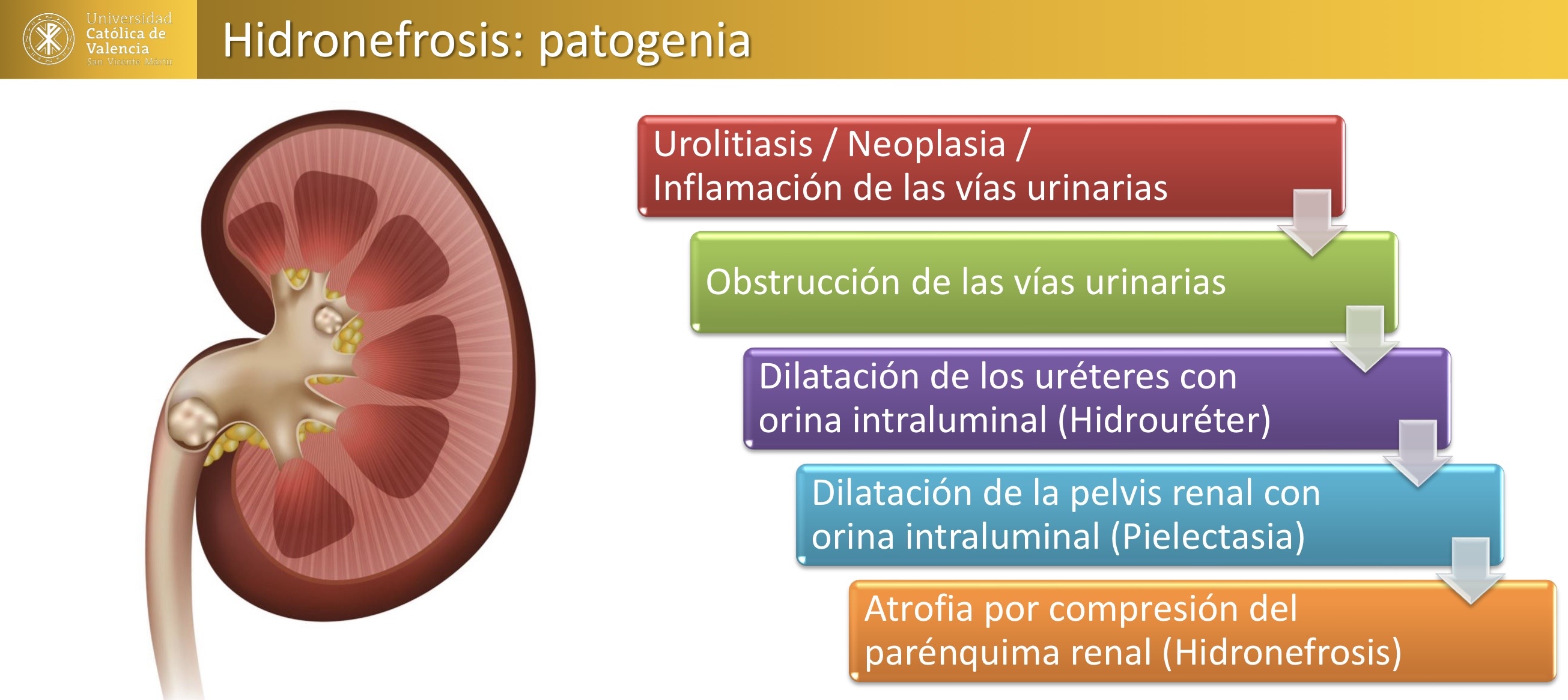 <p>RENAL: hidronefrosis </p><p>Asociada a atrofia por compresión </p>