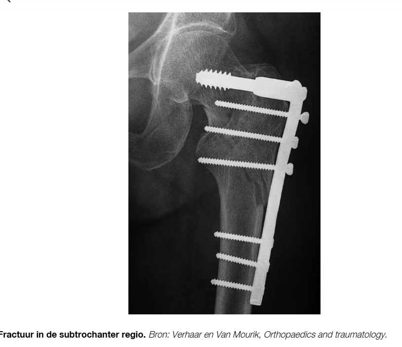 <p>jonge patienten als gevolg hoog energetisch truama. Ook vaak pathalogische fracturne. </p>