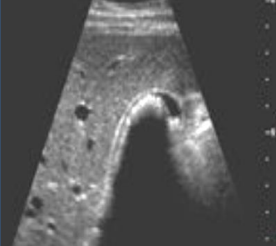 <p>what sonographic sign is this</p>