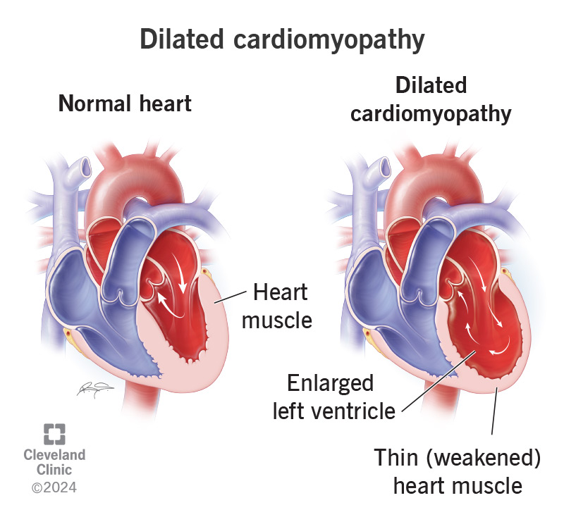 <p>Dilated cardiomyopathy </p>