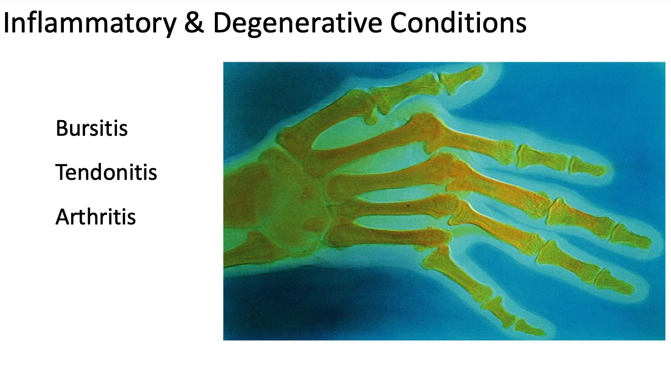 <p>Inflammation = Immune response</p><ul><li><p>Bursitis</p><ul><li><p>Irritation to bursa</p></li></ul></li><li><p>Tendonitis</p><ul><li><p>Irritation to tendons</p></li></ul></li><li><p>Artritis</p><ul><li><p>Hyaline cartilage degrading at ends of bones</p></li></ul></li></ul><p></p>