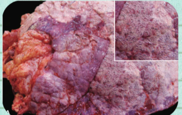 <p>What inflation disturbance is defined as a marked overdistention of alveoli with destruction of supporting alveolar and interstitial structures?</p>