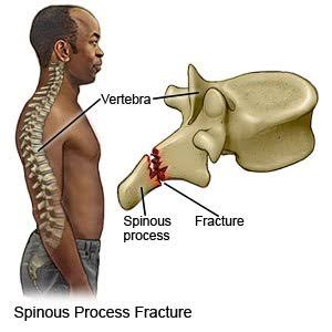 <p>the bony, ridge-like projection that extends backwards from the back of each vertebra</p>