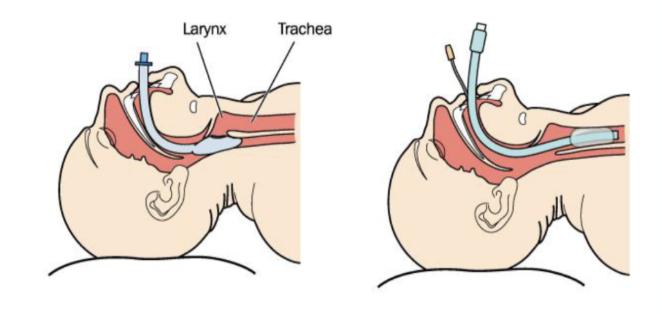 <ul><li><p>Is inserted through the mouth and past vocal cords into trachea</p></li><li><p>A cuff is inflated inside the trachea and below the vocal chords to seal the trachea </p></li><li><p>There is a balloon at the end of the tip which is inflated behind the vocal chords so that the tube cannot move  </p></li><li><p>With the balloon in place it pushes down the oesophagus a little bit, and it does not allow gastric contents to flow into the lungs which means aspiration is avoided </p></li></ul><p></p>