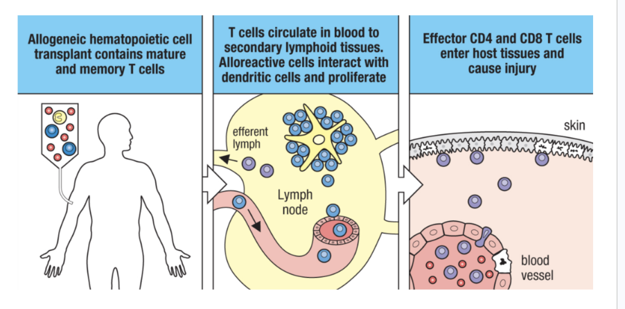 <p>Bone marrow transplant is generally used to treat leukemias and lymphomas</p><ul><li><p>rejection of recipient tissues by donor immune cells followign bone marrow </p><ul><li><p>1impacts the skin, intestines, and liver (alrady damaged by chemotherapy and raidation)</p></li><li><p>thats why attempts at inducing adult tolerance didnt go well</p></li></ul></li></ul><p>mechanism</p><p>1.. allogenic hmatopoetic cell transplant contains mature and memory t cells</p><p>t cells circulate in blood to secondary lymphoid tissues = alloreactie cells interact with dendritic cells and proliferate </p><p>effector cd4 and cd8 t cells enter host tissues and cause injuy</p><p></p>