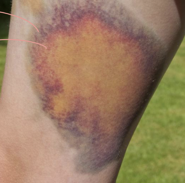 <ul><li><p>a force with enough energy to crush tissues</p></li><li><p>can be from 1 blow or repeated submaximal blows = damage in tissue (or even a fracture in bone)</p></li></ul><p></p>