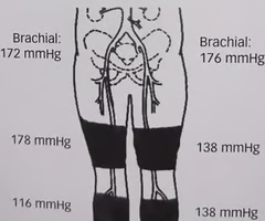 <p><span>What is the significance of the thigh pressure in the image?<br><br>A. They indicate bilateral aortoiliac disease, left side greater than the right<br><br>B. The pressures are consistent with proximal disease on the left<br><br>C. This study demonstrates bilateral inflow disease<br><br>D. This patient has significant right common iliac disease<br><br>E. You suspect the patient has incompressible vessels</span></p>