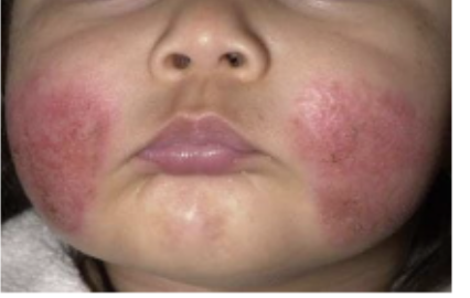 <p>Dermatosis reactiva pruriginosa crónica y recidivante, la cual se manifesta por una dermatosis aguda o crónica que afecta los pliegues, mejillas, párpados, cuello y manos principalmente </p>