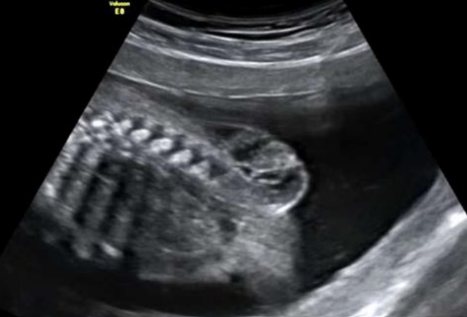 <p>What is this pathology?</p><p>a. Brachial cleft cyst</p><p>b. Encephalocele</p><p>c. Cystic hygroma</p><p>d. Myelomeningocele</p>