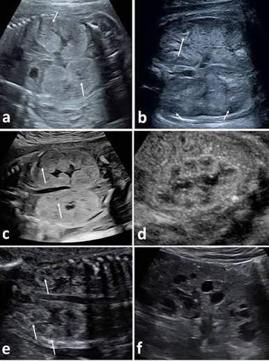 <p>Bilateral, enlarged echogenic kidneys</p><p>Absent urinary bladder</p><p>Oligohydramnios</p>