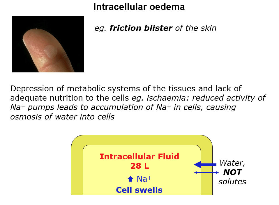 <p>Loss of ion within intra and extracellular environment</p>